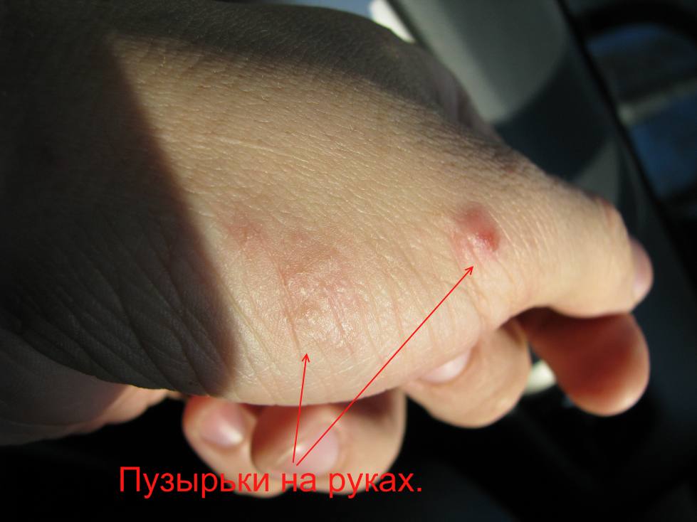 Под кожей на руках появились бугорки Под кожей на руках появились бугорки